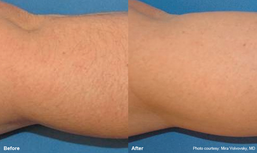 Before and After - Arm laser hair removal