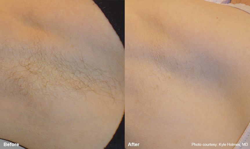 Before and After - Armpit laser hair removal