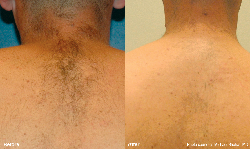 Before and After - Upper back laser hair removal