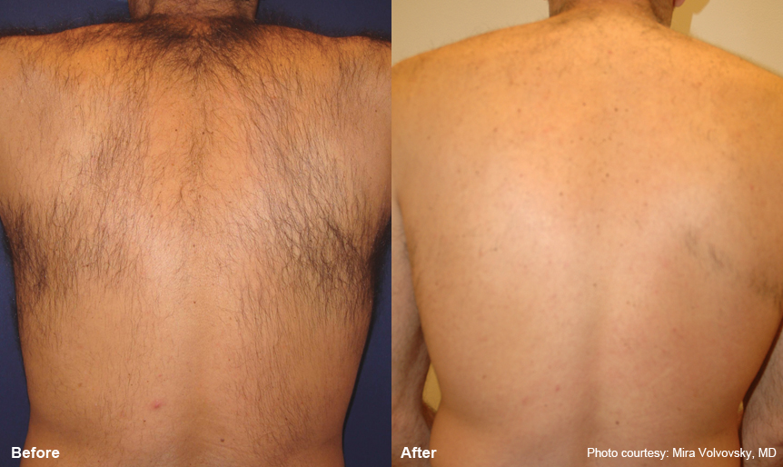 Before and After - Lower back laser hair removal