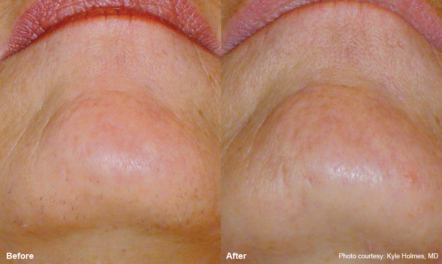 Before and After - Chin laser hair removal