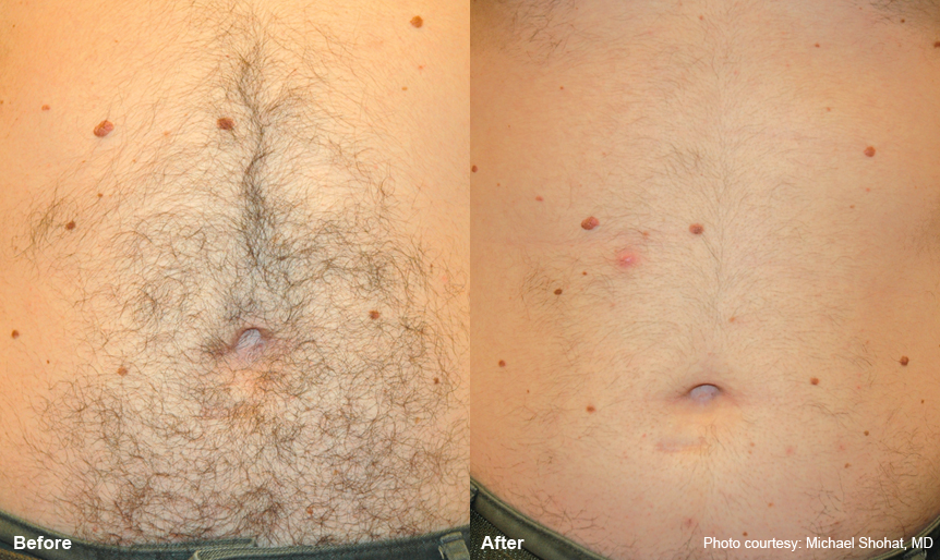 Before and After - Stomach laser hair removal